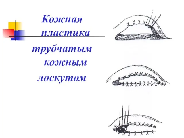 Кожная пластика трубчатым кожным лоскутом