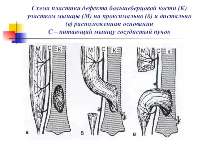 Схема пластики дефекта большеберцовой кости (К) участком мышцы (М) на проксимально (б)