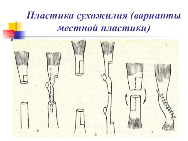 Пластика сухожилия (варианты местной пластики)