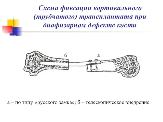 Схема фиксации кортикального (трубчатого) трансплантата при диафизарном дефекте кости а – по