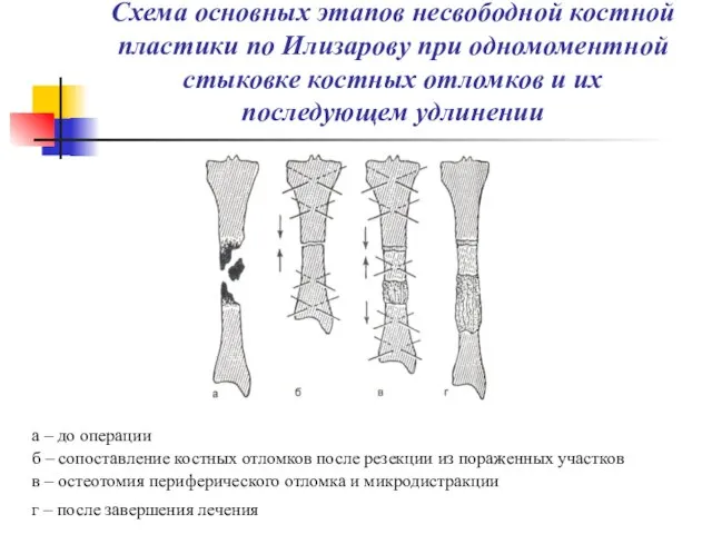 Схема основных этапов несвободной костной пластики по Илизарову при одномоментной стыковке костных