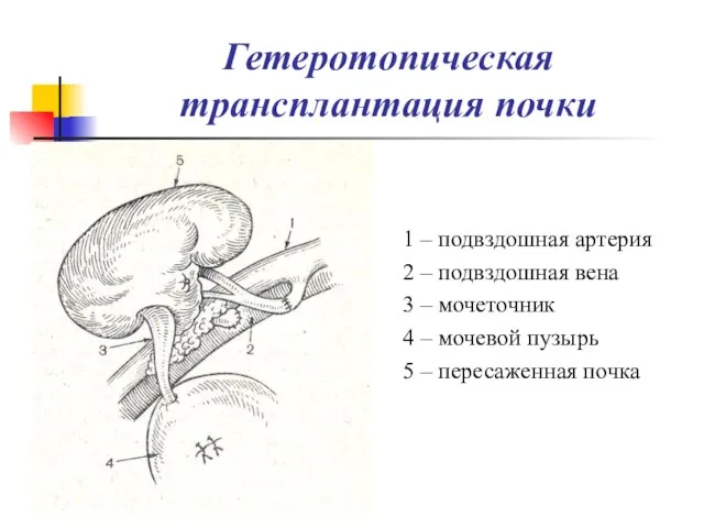 Гетеротопическая трансплантация почки 1 – подвздошная артерия 2 – подвздошная вена 3