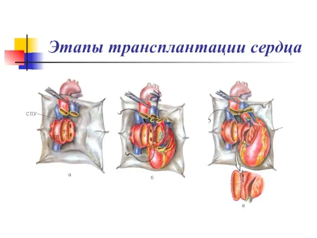 Этапы трансплантации сердца