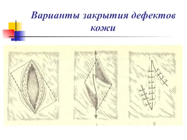 Варианты закрытия дефектов кожи