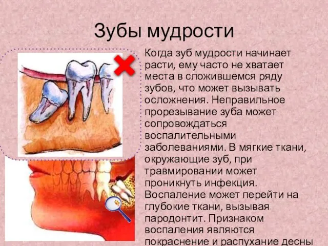 Зубы мудрости Когда зуб мудрости начинает расти, ему часто не хватает места