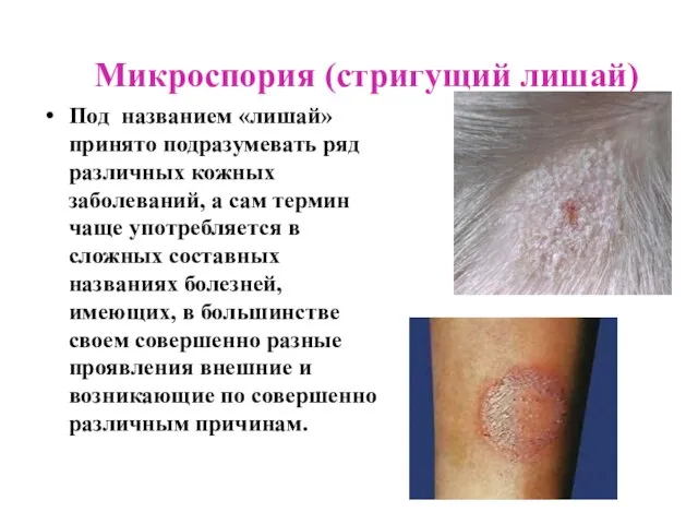 Микроспория (стригущий лишай) Под названием «лишай» принято подразумевать ряд различных кожных заболеваний,