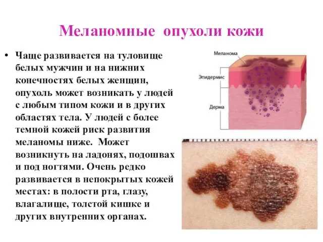 Меланомные опухоли кожи Чаще развивается на туловище белых мужчин и на нижних