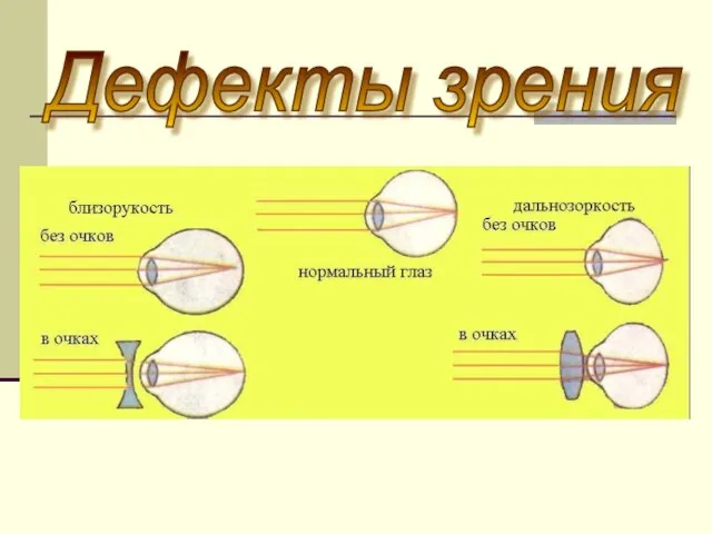 Дефекты зрения