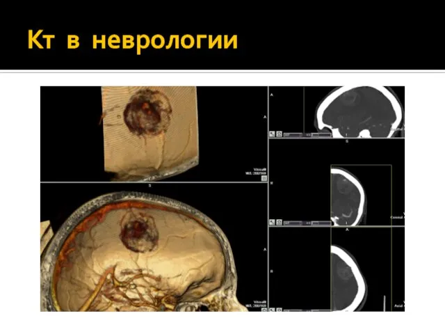 Кт в неврологии