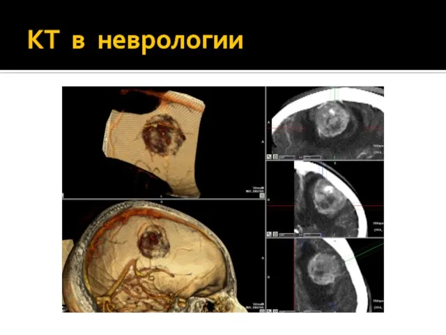 КТ в неврологии