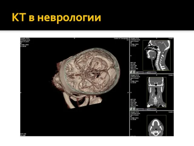 КТ в неврологии