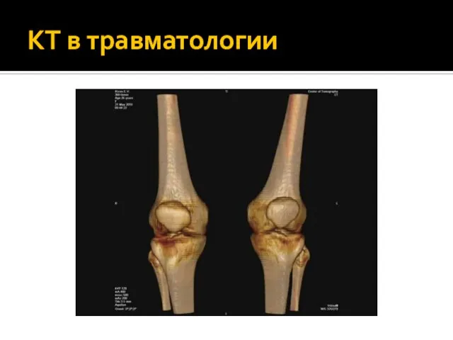 КТ в травматологии