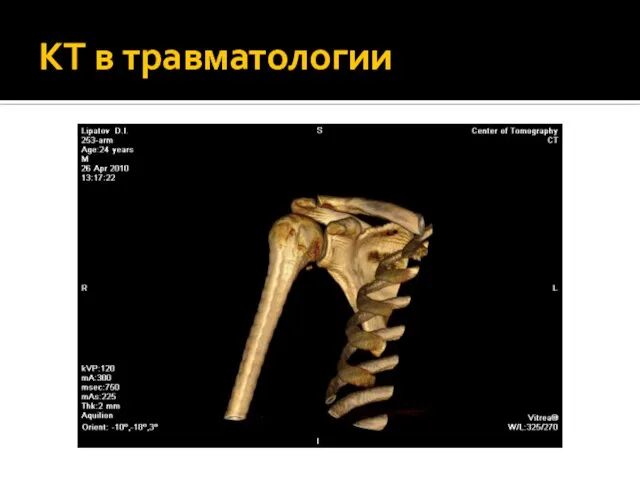 КТ в травматологии