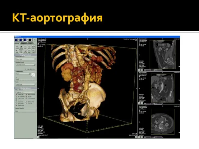 КТ-аортография