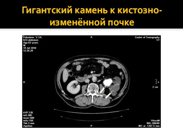 Гигантский камень к кистозно-изменённой почке