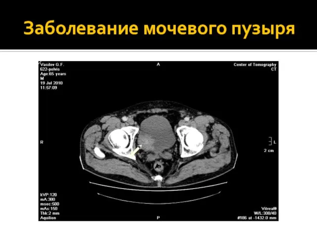 Заболевание мочевого пузыря