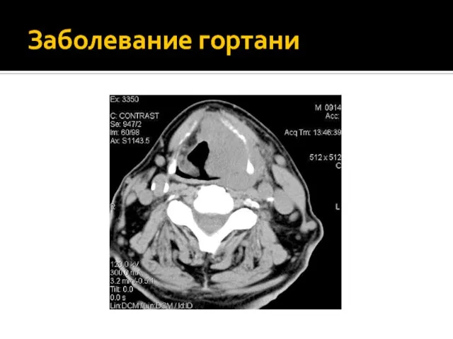 Заболевание гортани