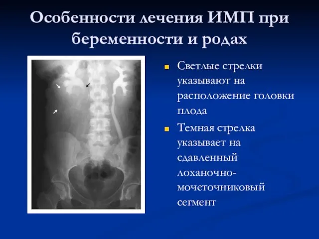 Особенности лечения ИМП при беременности и родах Светлые стрелки указывают на расположение