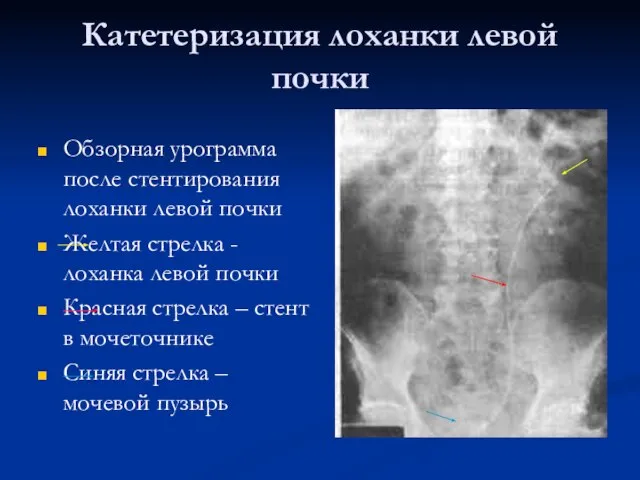 Катетеризация лоханки левой почки Обзорная урограмма после стентирования лоханки левой почки Желтая