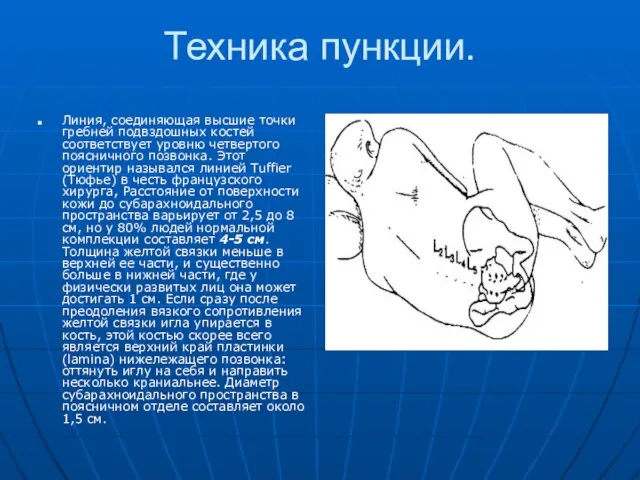 Техника пункции. Линия, соединяющая высшие точки гребней подвздошных костей соответствует уровню четвертого