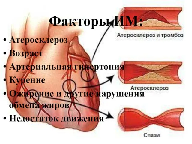 Факторы ИМ: Атеросклероз Возраст Артериальная гипертония Курение Ожирение и другие нарушения обмена жиров Недостаток движения