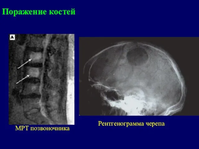 МРТ позвоночника Рентгенограмма черепа Поражение костей