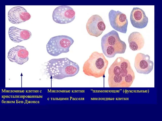 Миеломные клетки с кристализированным белком Бен-Джонса Миеломные клетки с тальцами Расселя “пламенеющие” (фуксильные) миелоидные клетки