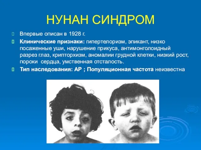 НУНАН СИНДРОМ Впервые описан в 1928 г. Клинические признаки: гипертелоризм, эпикант, низко