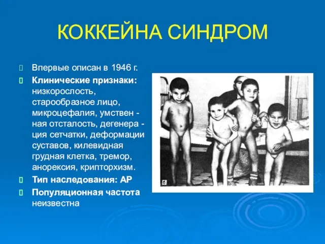 КОККЕЙНА СИНДРОМ Впервые описан в 1946 г. Клинические признаки: низкорослость, старообразное лицо,