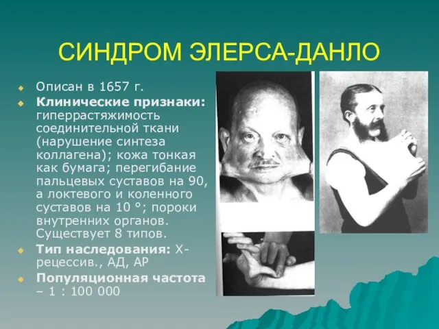 СИНДРОМ ЭЛЕРСА-ДАНЛО Описан в 1657 г. Клинические признаки: гиперрастяжимость соединительной ткани (нарушение