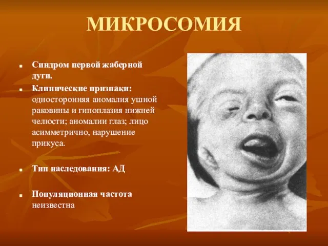 МИКРОСОМИЯ Синдром первой жаберной дуги. Клинические признаки: односторонняя аномалия ушной раковины и