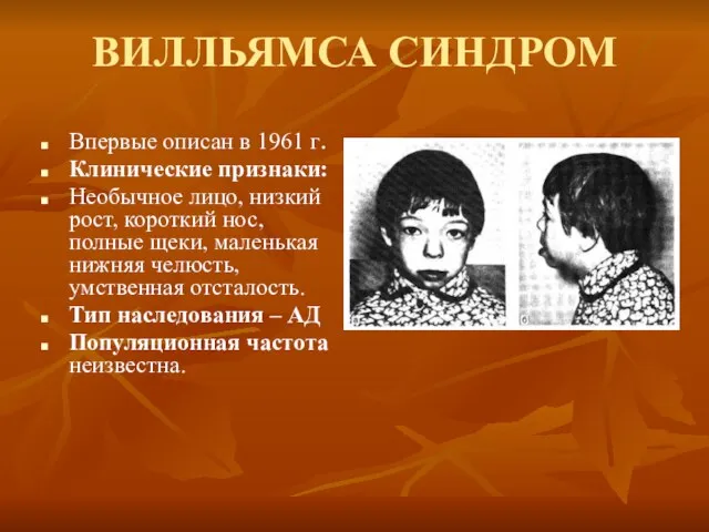 ВИЛЛЬЯМСА СИНДРОМ Впервые описан в 1961 г. Клинические признаки: Необычное лицо, низкий