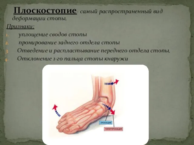 Плоскостопие- самый распространенный вид деформации стопы. Признаки: уплощение сводов стопы пронирование заднего