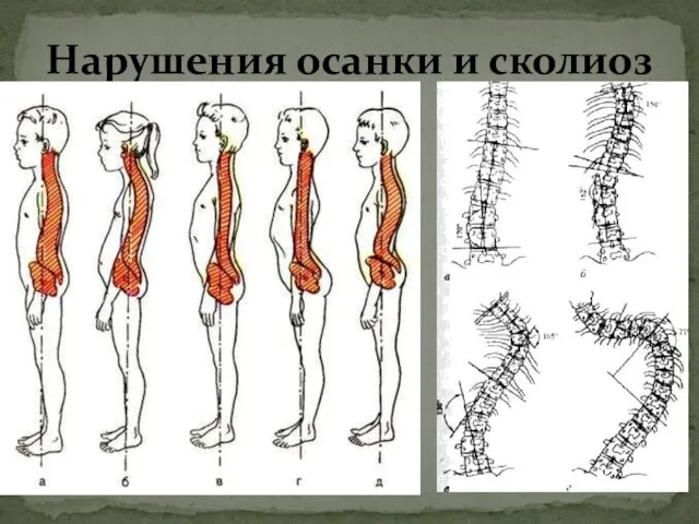 Нарушения осанки и сколиоз