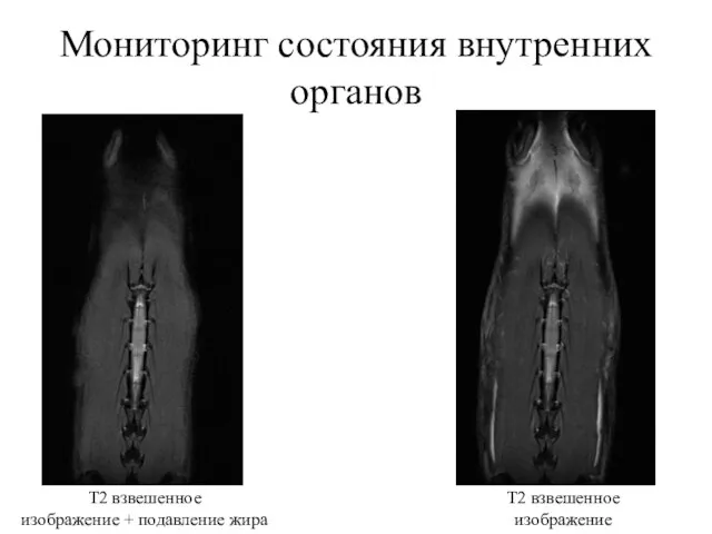 Мониторинг состояния внутренних органов Т2 взвешенное изображение Т2 взвешенное изображение + подавление жира