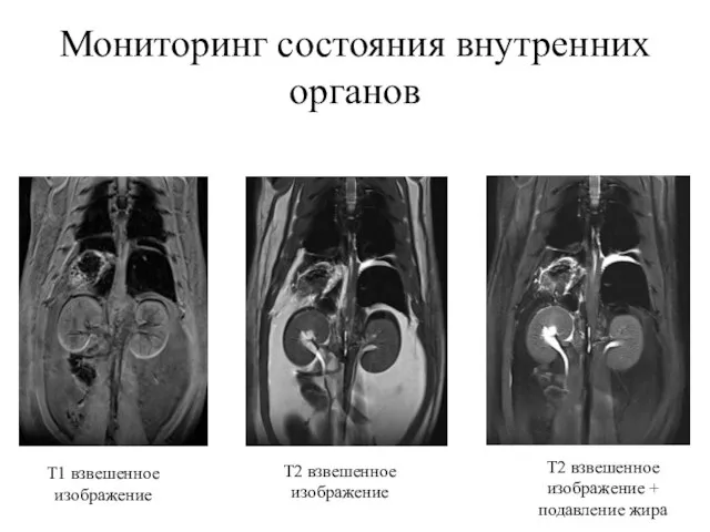 Мониторинг состояния внутренних органов Т1 взвешенное изображение Т2 взвешенное изображение Т2 взвешенное изображение + подавление жира