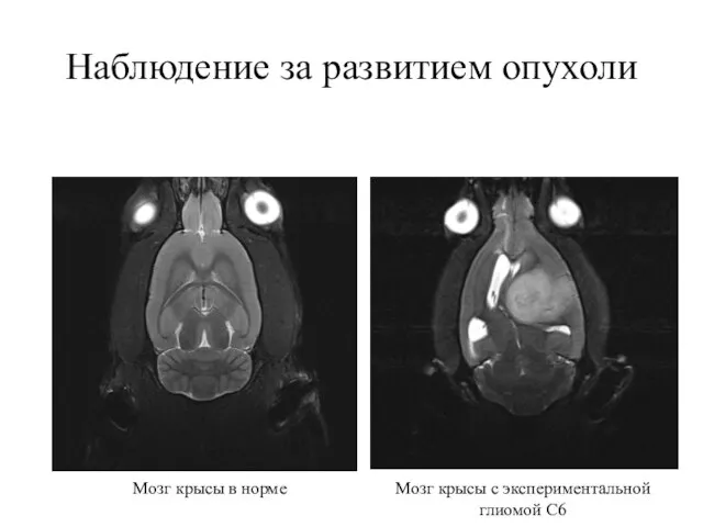 Наблюдение за развитием опухоли Мозг крысы в норме Мозг крысы с экспериментальной глиомой С6