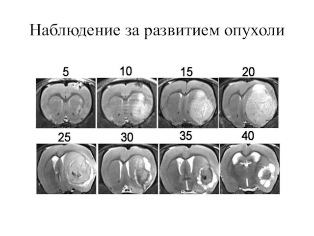 Наблюдение за развитием опухоли