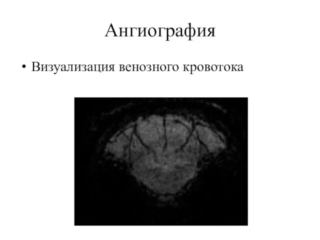 Ангиография Визуализация венозного кровотока