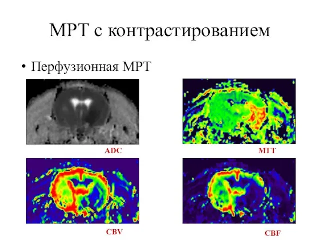 МРТ с контрастированием Перфузионная МРТ ADC CBV MTT CBF