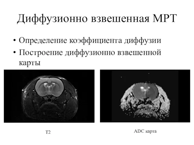 Диффузионно взвешенная МРТ Определение коэффициента диффузии Построение диффузионно взвешенной карты ADC карта T2