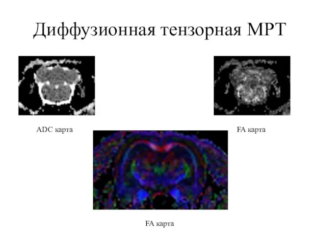 Диффузионная тензорная МРТ ADC карта FA карта FA карта