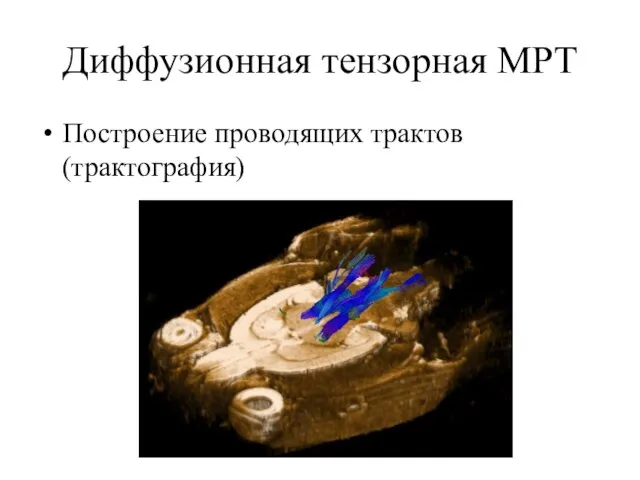 Диффузионная тензорная МРТ Построение проводящих трактов (трактография)