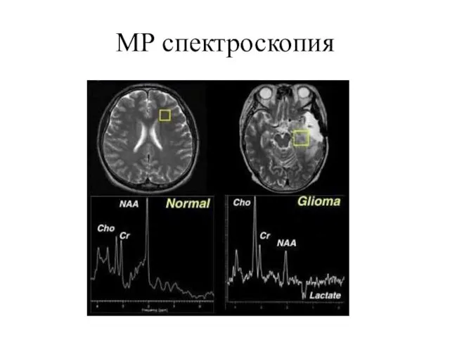 МР спектроскопия