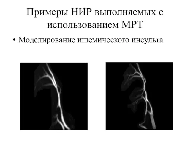 Примеры НИР выполняемых с использованием МРТ Моделирование ишемического инсульта