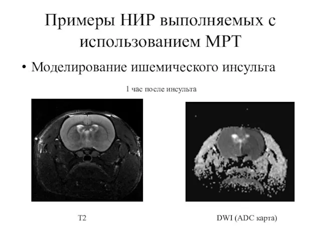 Примеры НИР выполняемых с использованием МРТ Моделирование ишемического инсульта Т2 DWI (ADC