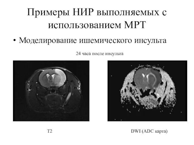 Примеры НИР выполняемых с использованием МРТ Моделирование ишемического инсульта Т2 DWI (ADC