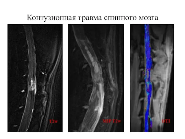 Контузионная травма спинного мозга T2w MIP T2w DTI