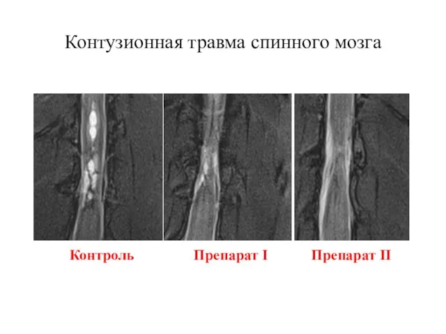 Контузионная травма спинного мозга