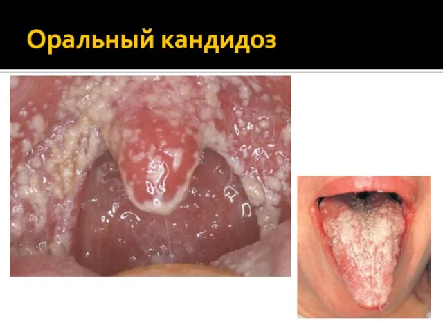 Оральный кандидоз